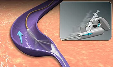 ClariVein Vein Ablation System